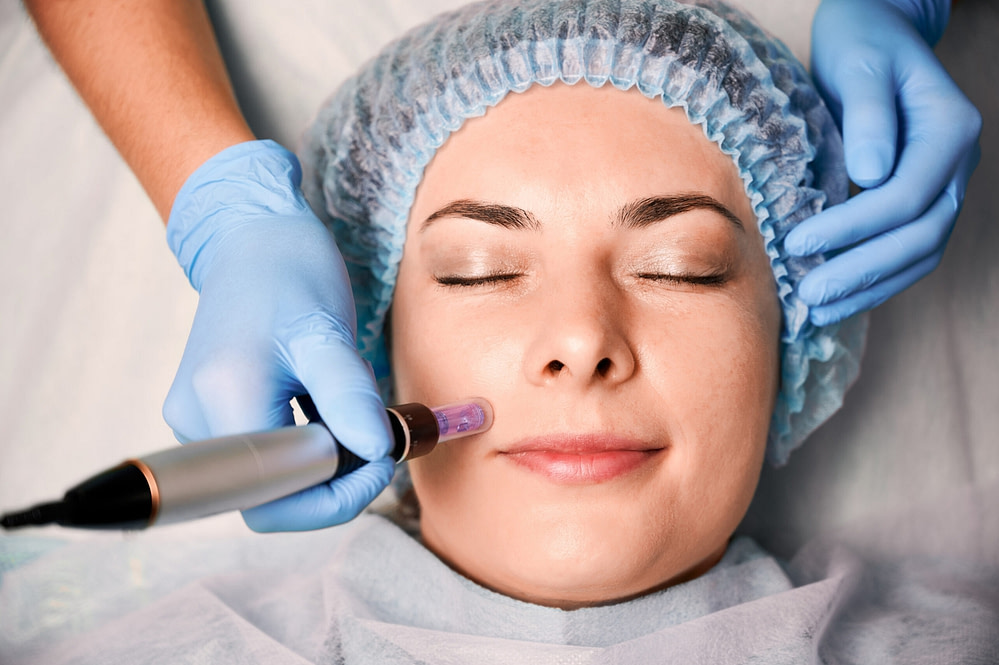 collagen induction therapy