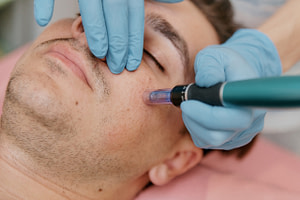 collagen induction therapy