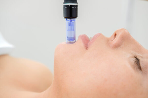 micro-needling