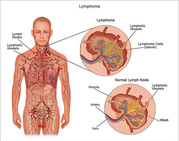 Lymphoma Glycerite